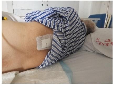 做右肾取石手术创口在左腰部 医院:严重差错,会补偿